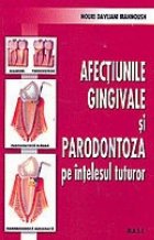 Afectiunile gingivale si parodontoza pe intelesul tuturor